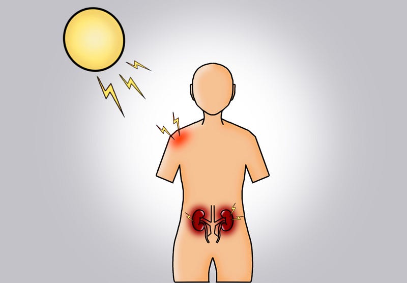 Diagram illustrating the effects of UV light on SLE